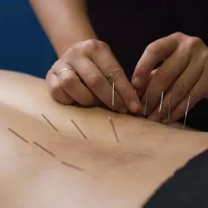 needling